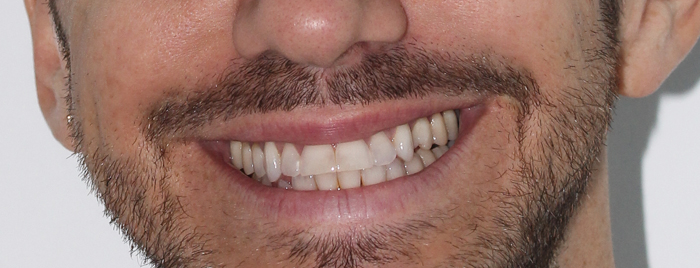 Andy antes