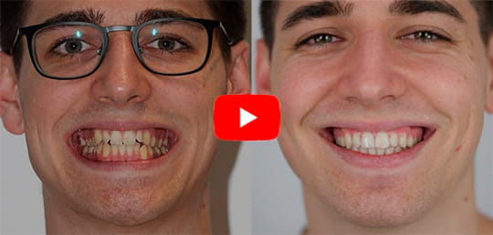 Antes y despupués Ortodoncia - Glowen